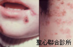 膿痂疹
