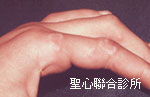單純庖疹